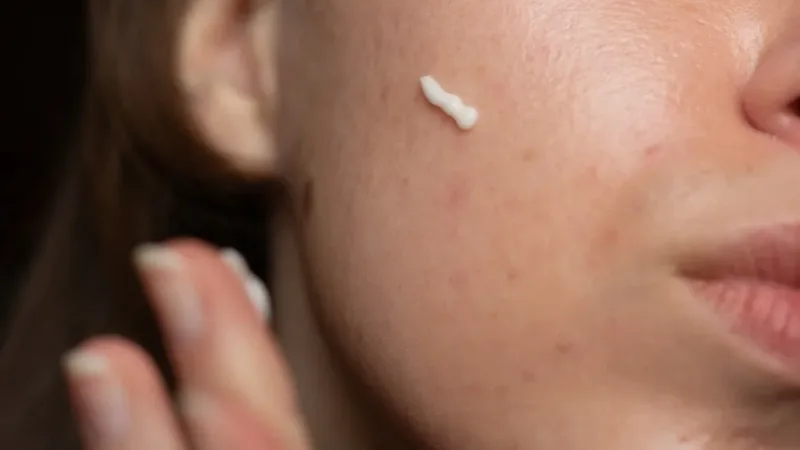 Tretinoin – Beneficii, Mod de utilizare si Recomandari
