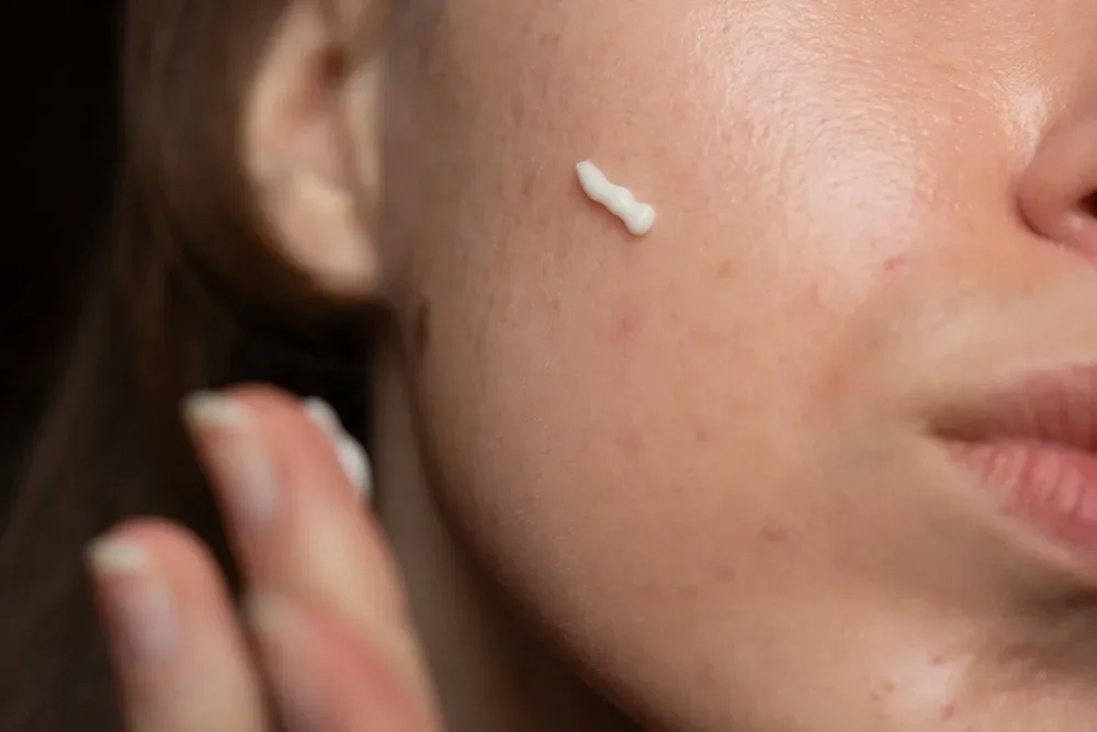 Tretinoin – Beneficii, Mod de utilizare si Recomandari